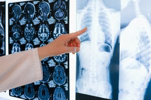 Artificial Intelligence (AI) for Disease Diagnosis